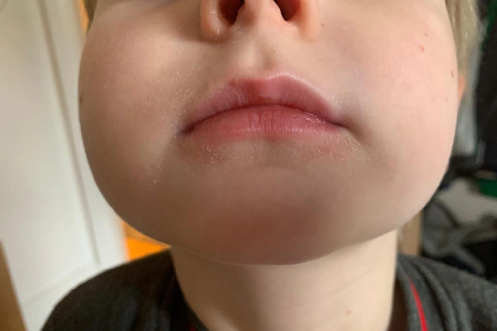 Patient 1 after