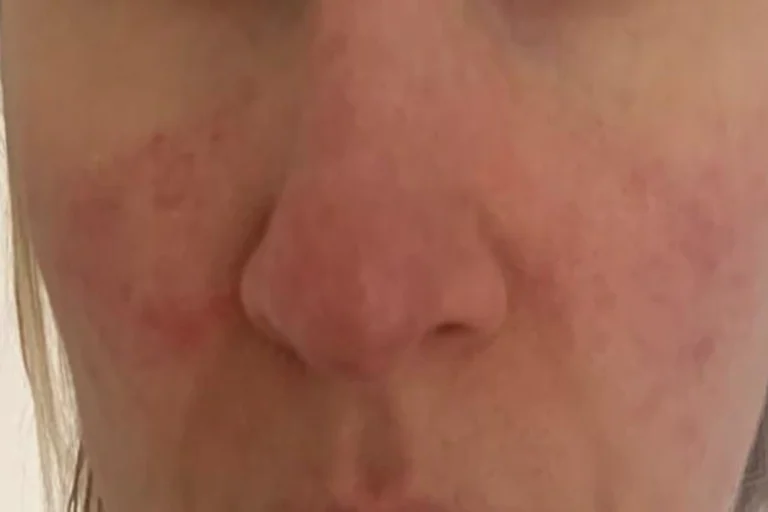 Patient 3 after