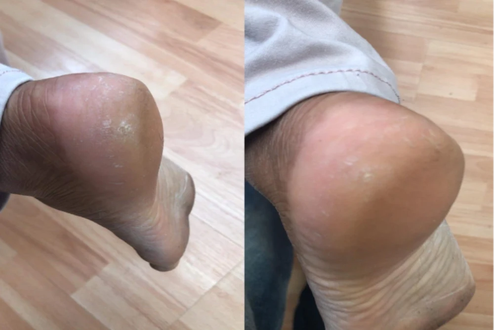 Patient 4 after