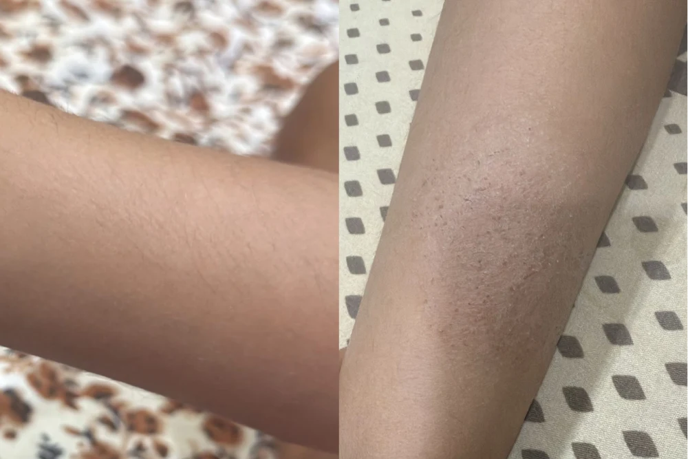 Dr Yogesh Sehgal Patients Before After