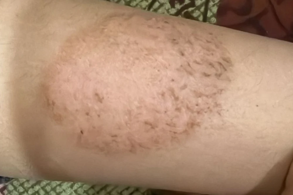 Dr Yogesh Sehgal Patients Before After