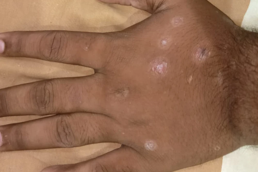 Dr Yogesh Sehgal Patients Before After