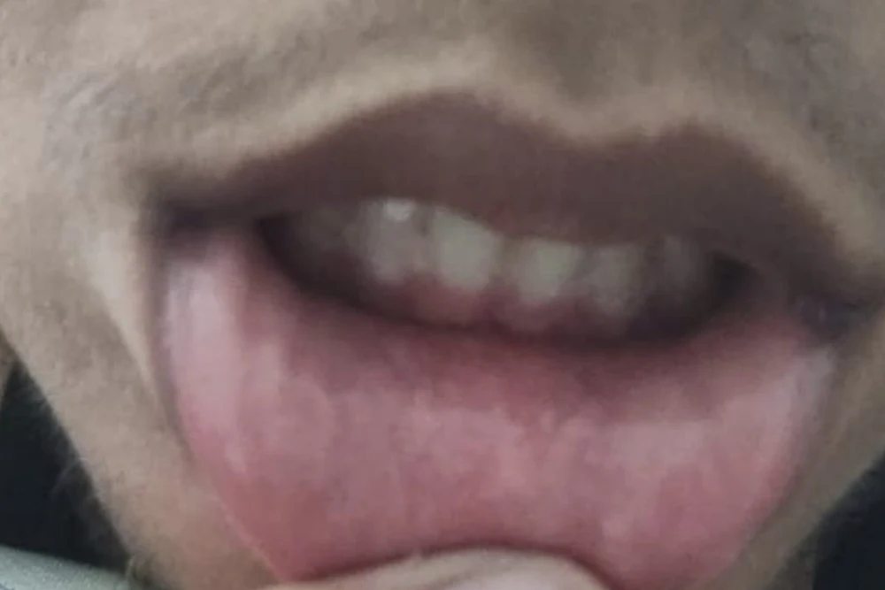 Dr Yogesh Sehgal Patients Before After